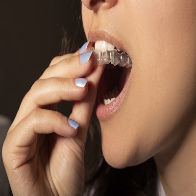 kobieta zakładająca nakładkę na zęby