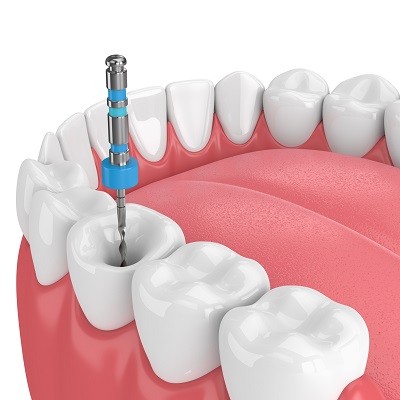 leczenie endodontyczne