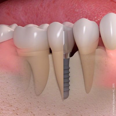 implant dentystyczny