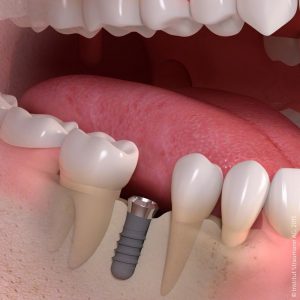 implant 2