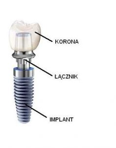 implant 7