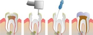 Leczenie endodontyczne