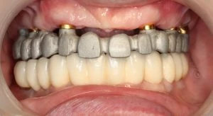 zęby  4