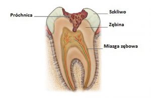 dziura w zębie - leczenie