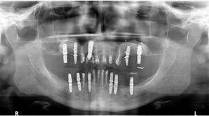 implanty stomatologiczne, podniesienie dna zatoki szczękowej