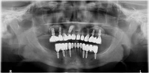 Veronadent Kraków dentysta, implanty, protetyka, zęby